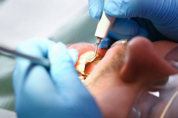 Best Emergency Root Canal Treatment in Ahoskie, NC